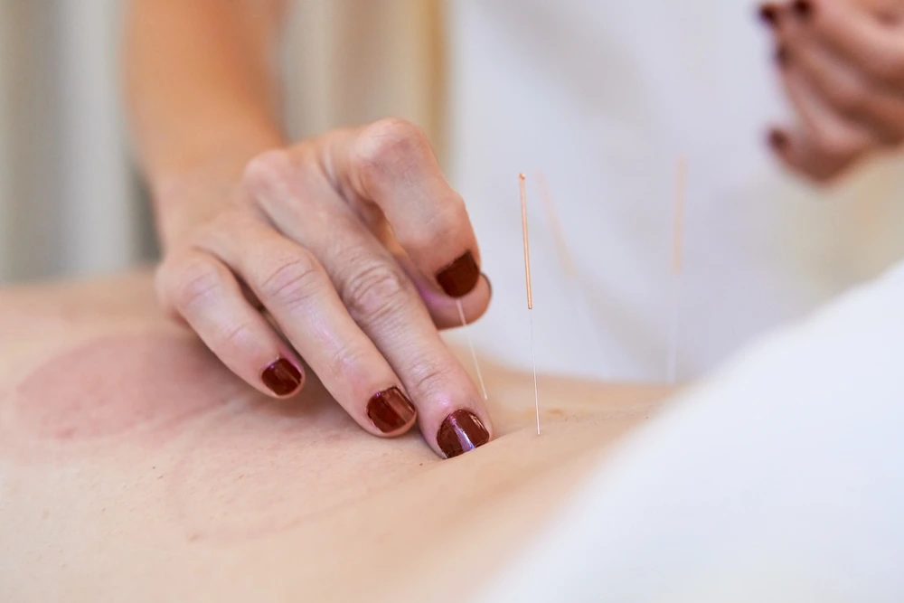 Acupuncture Treatment for Infertility in Gandhinagar