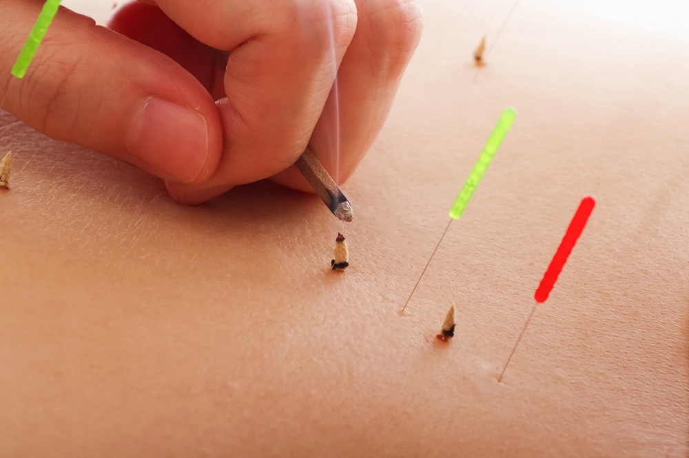 Acupuncture Treatment Centers in Ahmedabad 